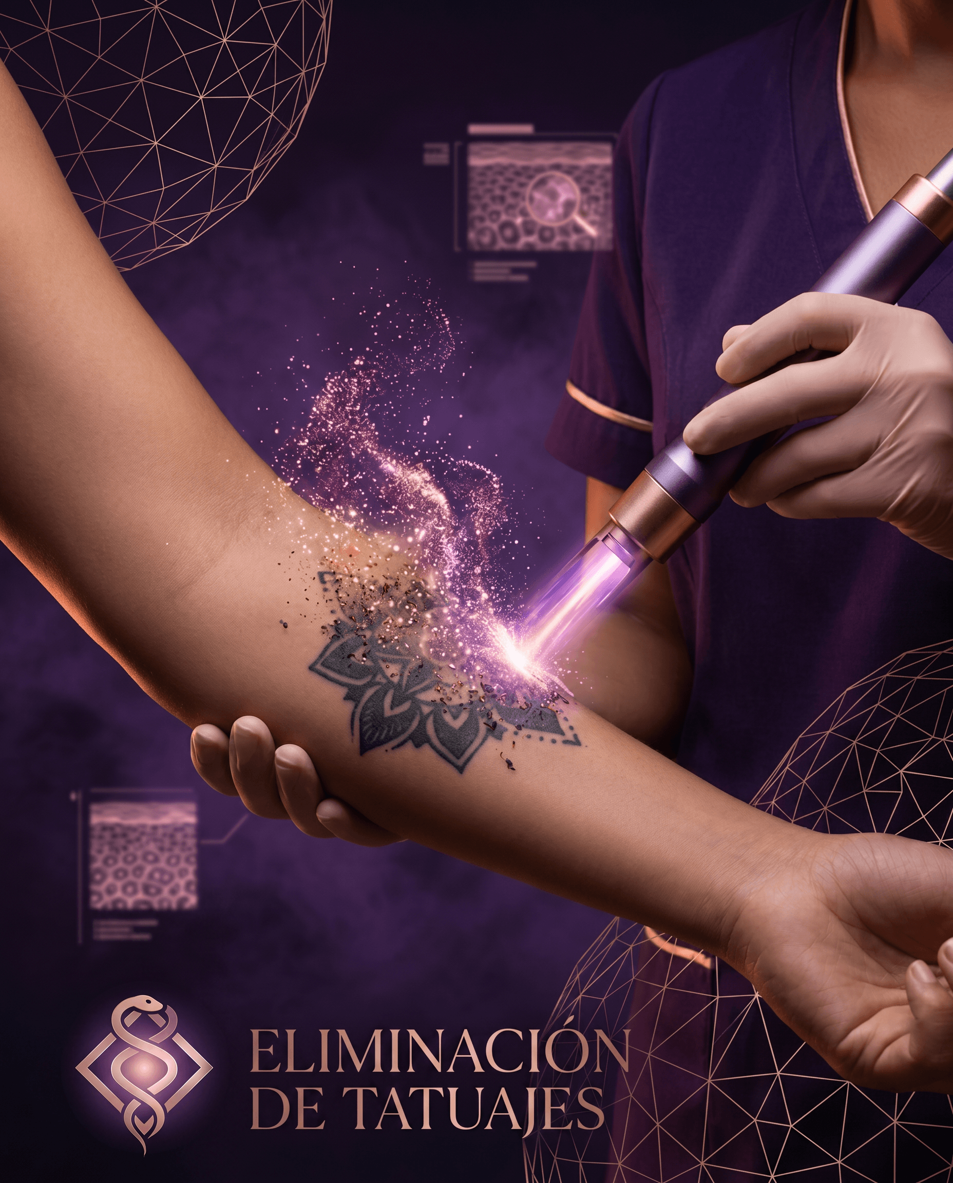 Eliminación de Tatuajes